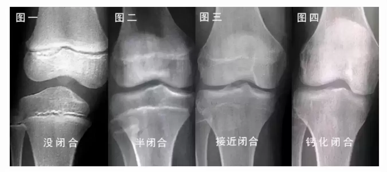 断骨增高的人现在都怎么样了？断骨增高的原理是什么，是不是智商税？